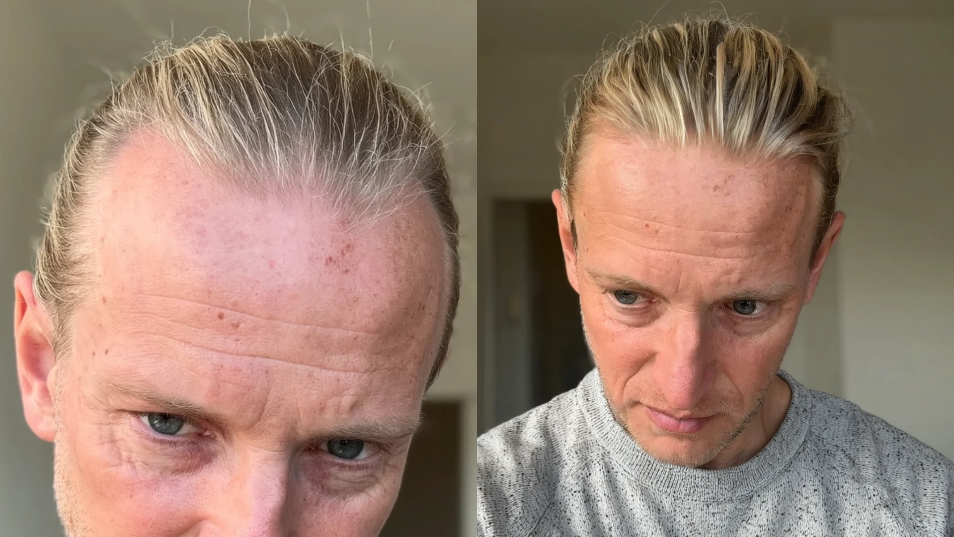 Before and after - Hairline and mid-scalp density
