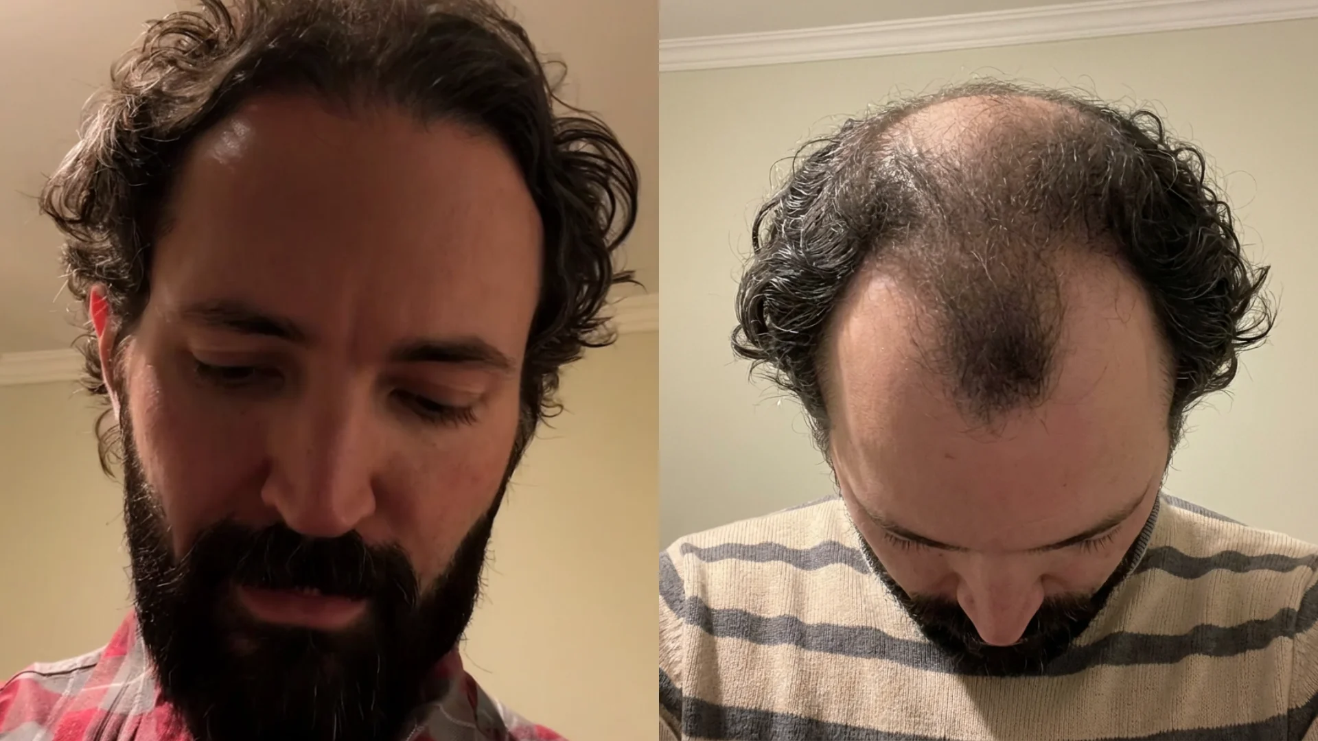 Post-transplant hair loss concern