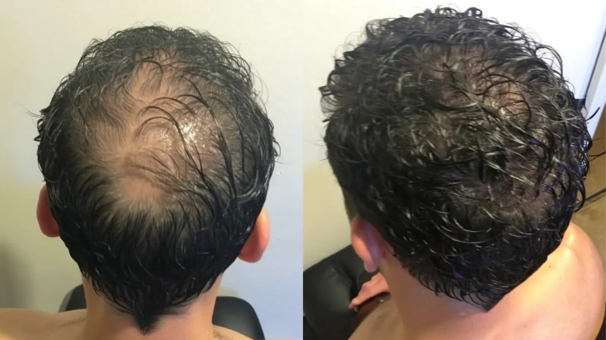 Before and after - Crown density