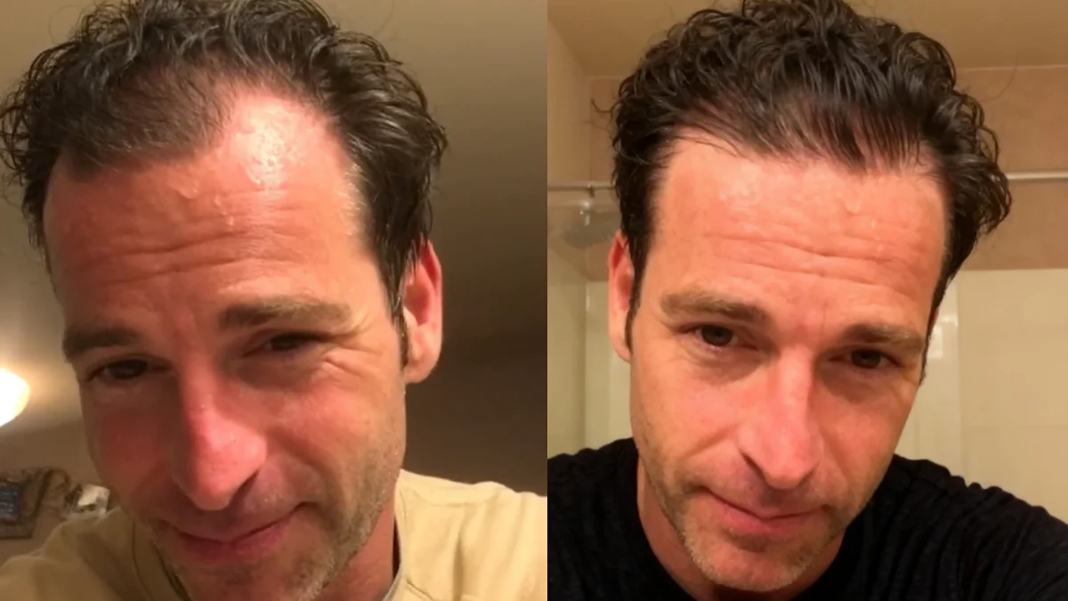 Before and after - Overall density and temples